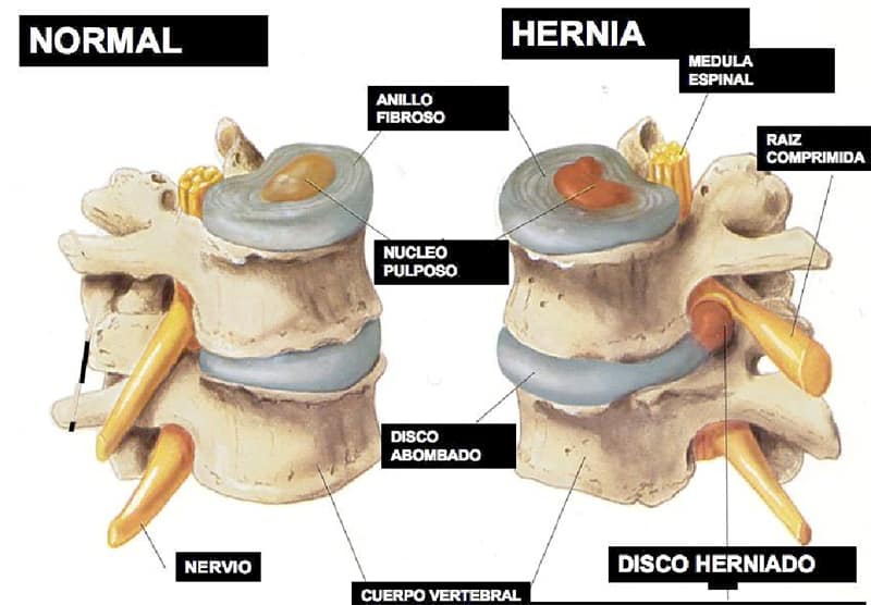 hernia-discal